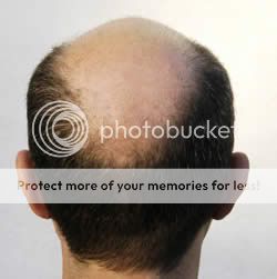hair photo:male hair loss 
